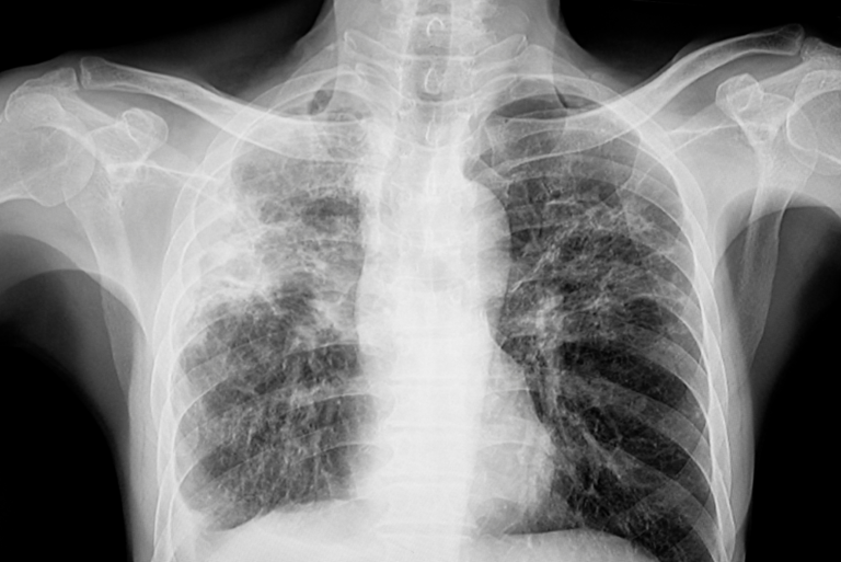 Don’t Downplay Prolonged Cough, TB Specialist Warns