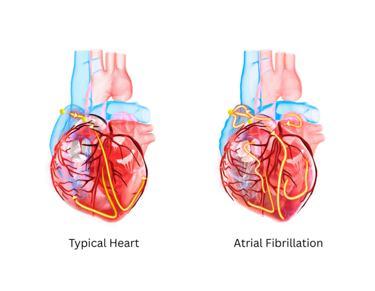 Atrial Fibrillation: Hidden Stroke Threat Affecting Malaysians